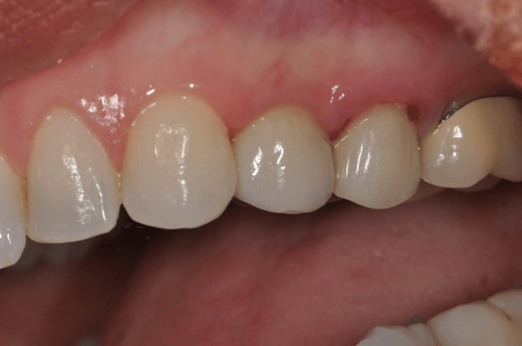 Advance Family Dentists;(336) 998-1076;149 Yadkin Valley Rd, Ste 101 Advance, NC 27006