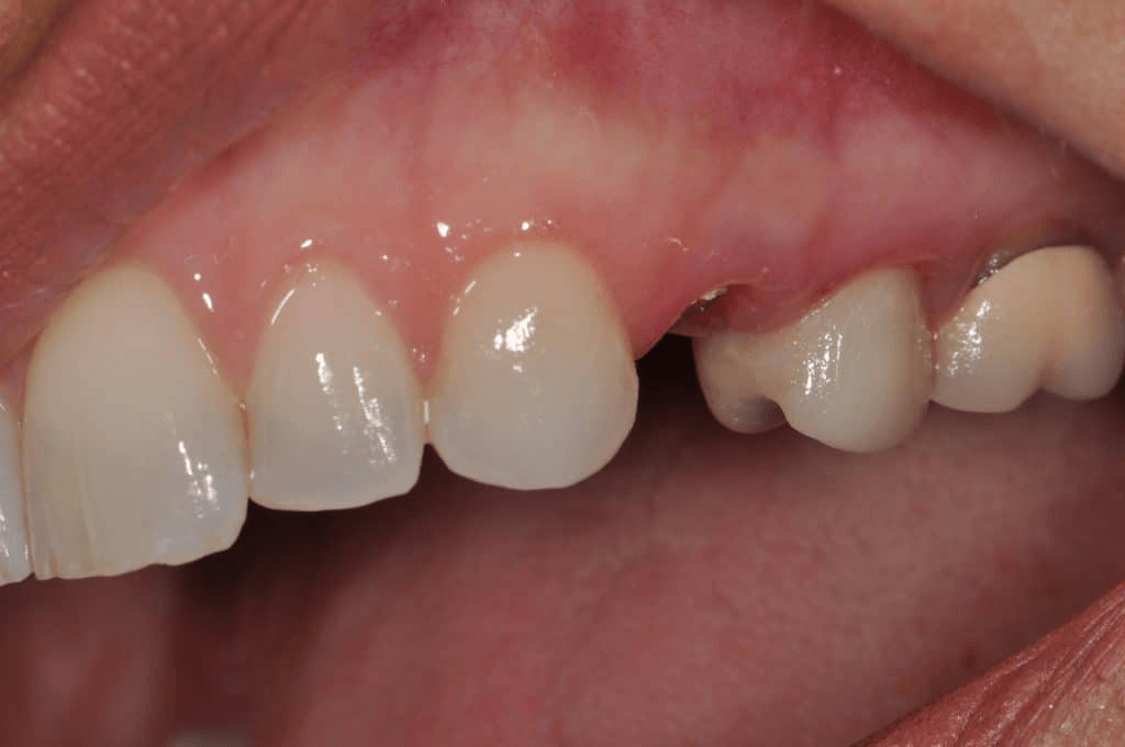 Advance Family Dentists;(336) 998-1076;149 Yadkin Valley Rd, Ste 101 Advance, NC 27006